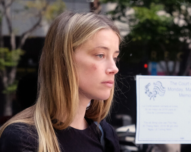 FORSLÅTT: Amber Heard dukket opp i retten med en blåveis som hun hevdet var et resultat av Johnny Depps fysiske mishandling. Foto: Ap FORSLÅTT: Amber Heard dukket opp i retten med en blåveis som hun hevdet var et resultat av Johnny Depps fysiske mishandling. Foto: Ap
